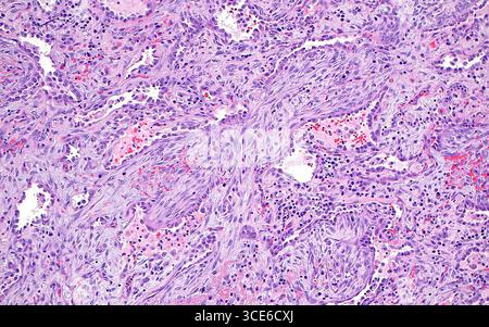 La micrographie à la lumière des pneumonies organisatrices. La pneumonie organisatrice est un modèle de lésion pulmonaire dans lequel les fibroblastes (lignes violettes allongées et sinueuses) prolifèrent et remplissent les espaces dans les alvéoles (espaces blancs). On peut également voir sur cette image d'autres cellules inflammatoires (points bleu foncé) et globules rouges (points rouge vif). Coupe de tissu colorée à l'hématoxyline et à l'éosine. Grossissement : 100x lorsqu'il est imprimé à 10cm. Banque D'Images