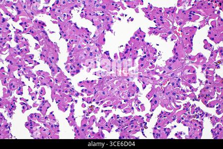 Carcinome papillaire à cellules rénales à la lumière. Le carcinome papillaire à cellules rénales est un sous-type de cancer du rein. Un des motifs microscopiques observés dans cette tumeur est la formation de cellules éosinophiles (rose). Les cellules tumorales ont un cytoplasme abondant (rose) et des noyaux plus petits (points bleus ronds). Coupe de tissu colorée à l'hématoxyline et à l'éosine. Grossissement : 200x lorsqu'il est imprimé à 10cm. Banque D'Images