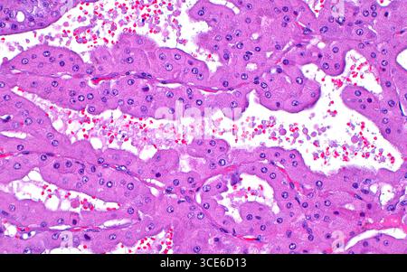 Micrographie lumineuse d'un carcinome à cellules rénales associé à une maladie kystique acquise. Ce type de cancer du rein survient exclusivement dans les reins atteints de maladie kystique des reins acquise, qui est une forme de maladie rénale terminale dans laquelle les reins affectés acquièrent de multiples kystes. Cette tumeur peut présenter des profils morphologiques variés, dont l'un est des cellules oncocytaires avec un cytoplasme éosinophile (rose) abondant. Dans cet exemple, les cellules oncocytaires sont disposées dans des papilles ou des projections de cellules en forme de doigts. Coupe de tissu colorée à l'hématoxyline et à l'éosine. Grossissement : 200x lorsqu'il est imprimé à 10cm. Banque D'Images