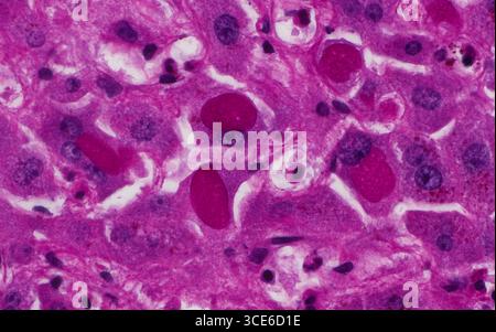 Micrographie à la lumière des inclusions de verre broyé de cellules hépatiques. Des inclusions de verre broyé (structures ovoïdes magenta foncé) peuvent être observées dans les cellules hépatiques (rose-violet plus clair) des patients atteints d'hépatite B, de greffes de foie ou prenant certains médicaments. Les noyaux des cellules hépatiques sont les plus petites structures rondes violettes foncées à côté des inclusions de verre broyées, qui sont dans le cytoplasme des cellules hépatiques. Coupe de tissu coloré à l'acide périodique de Schiff (pas). Grossissement : 600x lorsqu'il est imprimé à 10cm. Banque D'Images