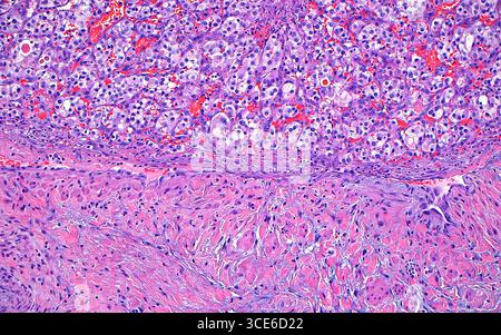 Micrographie lumineuse d'un thrombus tumoral d'un carcinome à cellules rénales. Cette image montre un thrombus de carcinome rénal à cellules claires (moitié supérieure de l'image) attaché à la paroi de la veine rénale (moitié inférieure de l'image). La thrombose des cellules tumorales dans la veine rénale indique un stade de cancer plus élevé et une tumeur plus agressive. Coupe de tissu colorée à l'hématoxyline et à l'éosine. Grossissement : 100x lorsqu'il est imprimé à 10cm. Banque D'Images