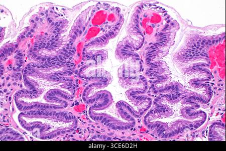 Hyperplasie fovéolaire par micrographie à la lumière. L'épithélium fovéolaire est constitué des cellules tapissant l'estomac. Lorsqu'elle est irritée ou blessée, la muqueuse fovéolaire peut subir une hyperplasie réactive, dans laquelle elle prend un aspect ondulé ou tortueux comme on le voit sur l'image. Les cellules fovéolaires ont un cytoplasme myxoïde clair (blanc à gris clair). Le tissu conjonctif entre les glandes fovéolaires réactives est principalement éosinophile (rose) et contient des vaisseaux sanguins (rouge vif). Coupe de tissu colorée à l'hématoxyline et à l'éosine. Grossissement : 200x lorsqu'il est imprimé à 10cm. Banque D'Images