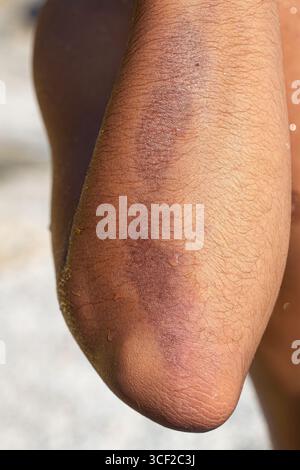 Gros plan d'un gros hématome sous la peau sur le bras d'un patient, indiquant un saignement interne et une blessure potentielle Banque D'Images