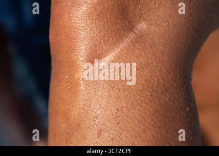 Gros plan d'une cicatrisation postopératoire sur peau en sueur, mettant en évidence la santé de la peau et la récupération médicale Banque D'Images
