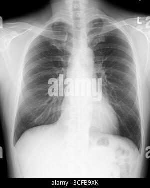 Filmer thorax PA normal. La taille du coeur, le diaphragme et les sillons costophréniques sont normaux, aucune infiltration pulmonaire dans les deux poumons, thorax osseux non remarquable. Banque D'Images