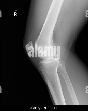 Filmez la vue latérale normale du genou droit. Un petit épanchement articulaire est observé, aucune ligne de fracture ou luxation n'est notée, l'espace articulaire est préservé. Banque D'Images