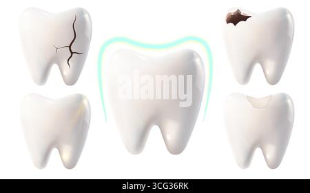 Dents blanches et dents avec divers stades de carie et de dommages, une dent avec obturation et une dent sous protection sur fond blanc, Illustration de Vecteur