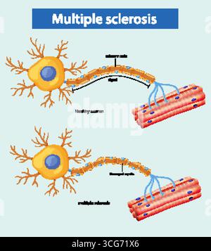 Illustration vectorielle comparant des neurones sains et affectés par la sclérose en plaques, montrant des lésions de la gaine de myéline et une perturbation du signal. Illustration de Vecteur