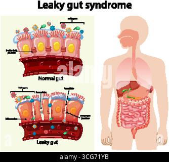 Diagramme vectoriel plat comparant l'intestin sain et fuyant, montrant l'inflammation, les jonctions serrées et la perméabilité. Illustration de Vecteur
