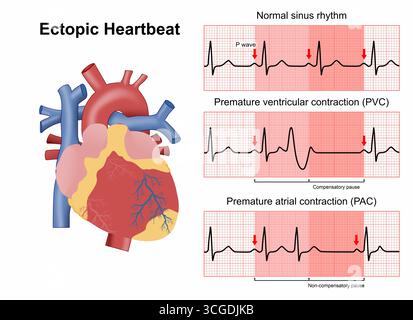 Illustration médicale de flashcard de battement de coeur ectopique Banque D'Images