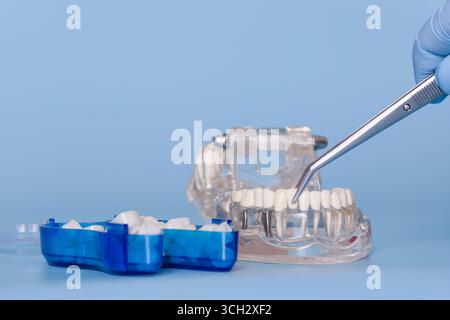 Gros plan d'une main gantée à l'aide d'une pince à épiler pour positionner une dent prothétique sur un modèle de mâchoire transparente, avec boîtier bleu de dents de rechange à proximité. Banque D'Images