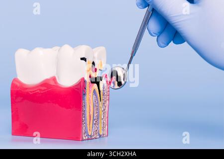 modèle dentaire présentant une structure dentaire et une cavité, examiné avec un miroir dentaire par une main gantée. Modèle dentaire montrant la carie et l'anatomie Banque D'Images