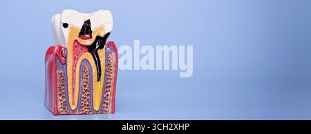 Gros plan d'un modèle de dent anatomique montrant une carie sévère pénétrant l'émail et la dentine, avec une pulpe visible et une structure racinaire sur fond bleu. Banque D'Images