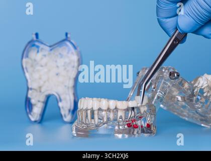 Main gantée à l'aide d'une pince à épiler pour positionner une couronne dentaire sur un modèle de mâchoire transparent, avec récipient de dents de rechange en arrière-plan. Banque D'Images