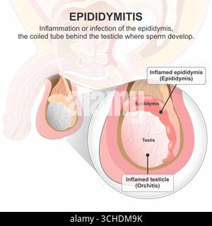 Illustration de flashcard médical de testicule enflammé de l'épididymite Banque D'Images
