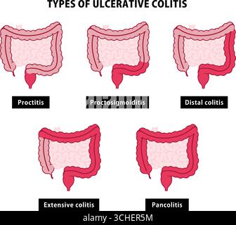 Types de rectocolites hémorragiques. Illustration vectorielle Illustration de Vecteur
