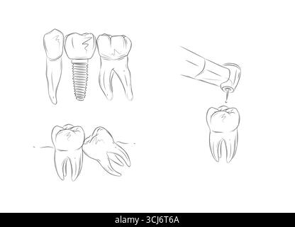 Percer la dent avec une machine dentaire, un implant, enlever les dents malades illustrations dessin dans un style graphique avec noir sur fond blanc. Illustration de Vecteur