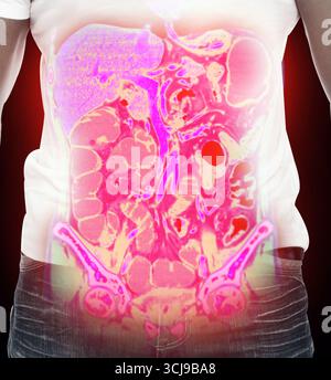 Superposition innovante de tomodensitométrie abdominale 3D sur le corps humain, illustrant la radiologie moderne et l'imagerie diagnostique pour la santé et la détection des maladies. Banque D'Images