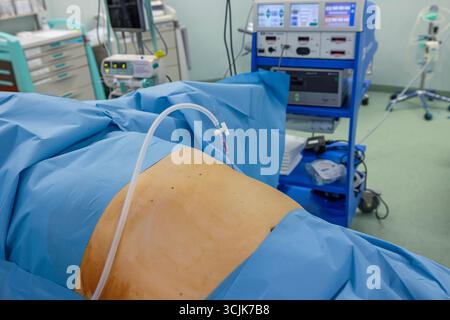 Chirurgien bariatrique pratiquant un manchon gastrique pour traiter l'obésité, gros plan des mains et instruments chirurgicaux. Banque D'Images