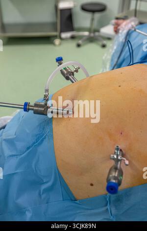Chirurgien bariatrique pratiquant un manchon gastrique pour traiter l'obésité, gros plan des mains et instruments chirurgicaux. Banque D'Images