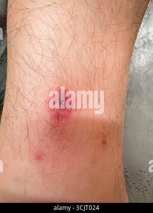 Gros plan macro d'une piqûre d'insecte sévère, rouge et enflammée avec une piqûre centrale sur la jambe poilue d'une personne, montrant une réaction allergique douloureuse Banque D'Images
