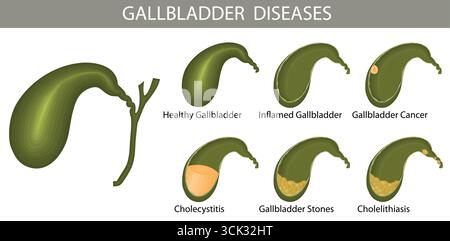 Illustration médicale des maladies de la vésicule biliaire, y compris la vésicule biliaire saine, inflammation, cancer, cholécystite, calculs biliaires, et la lithiase biliaire. Illustration de Vecteur