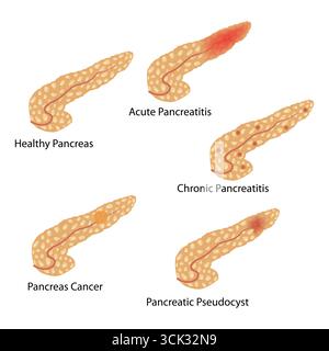 Diagramme de comparaison médicale des conditions du pancréas : pancréas sain, pancréatite aiguë et chronique, cancer du pancréas, pseudokyste pancréatique. Illustration de Vecteur