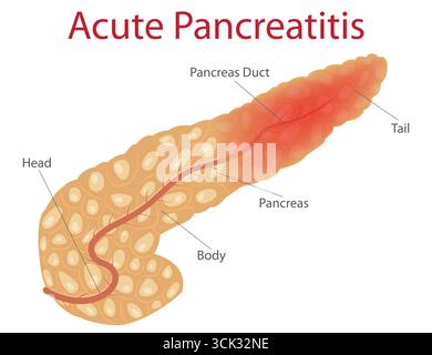 Schéma illustrant l'anatomie du pancréas et les effets inflammatoires de la pancréatite aiguë. Illustration de Vecteur