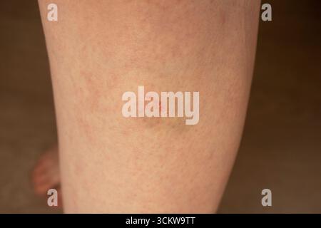 gros plan d'une ecchymose et d'une blessure sur la jambe de la femme Banque D'Images