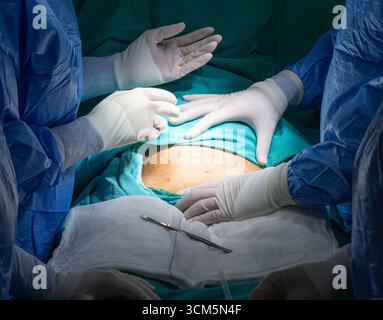 Césarienne. Les chirurgiens pratiquant une césarienne en salle d'opération. Banque D'Images