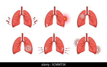 Douleurs pulmonaires. Pathologie des organes internes humains. Diagnostic médical et traitement des poumons. Ensemble d'illustration vectorielle dans le style de dessin animé plat Illustration de Vecteur