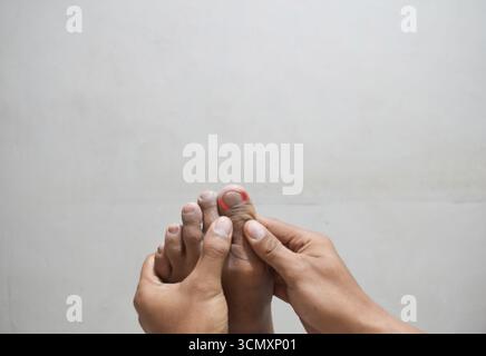 ongles incarnés sur un pied d'homme, douleur dans le gros orteil isolé sur fond beige Banque D'Images