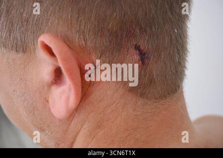 Personne guérissant d'une chirurgie d'ablation de lésion cutanée avec des points de suture visibles. Banque D'Images