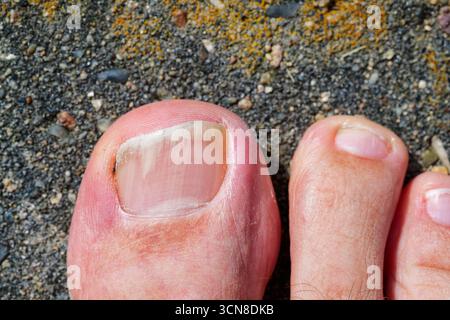 Macro gros plan de l'ongle d'orteil humain avec infection fongique visible. Concept pour la santé du pied de champignon ongle onychomycose, traitement médical, dermatologie, et h. Banque D'Images