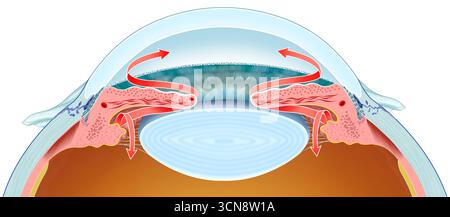 Illustration du drainage de l'humeur aqueuse dans le glaucome. L'accumulation de ce liquide oculaire augmente la pression intraoculaire et endommage le nerf optique, ce qui peut entraîner une perte de vision et la cécité. Banque D'Images