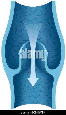 Illustration montrant une veine avec une valvule variqueuse, où le dysfonctionnement de la valvule permet le reflux sanguin et empêche le retour veineux vers le cœur. Les valvules veineuses endommagées ne se ferment pas correctement, ce qui provoque une accumulation de sang, une dilatation des veines et le développement de varices. Banque D'Images