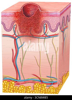 Illustration montrant la peau avec mélanome ulcéré, un type de cancer de la peau, qui présente une rupture dans la peau sus-jacente. Cette ulcération est un facteur important dans la classification du mélanome car elle indique un risque plus élevé de propagation par rapport au mélanome non ulcéré. Banque D'Images