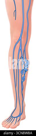 Illustration montrant une jambe atteinte de varices. Ce sont des veines dilatées, allongées et tordues qui gonflent sous la peau. Les varices sont causées par des valves défectueuses, qui provoquent une accumulation de sang et une pression dans les veines superficielles. Les signes visibles tels que gonflement, changements de couleur et douleur sont mis en évidence. Banque D'Images