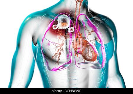 Tuberculose cavitaire dans le lobe supérieur du poumon droit. Illustration montrant des lésions pulmonaires et des cavités. Banque D'Images