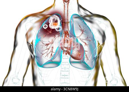 Tuberculose cavitaire dans le lobe supérieur du poumon droit. Illustration montrant des lésions pulmonaires et des cavités. Banque D'Images