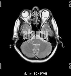 Imagerie par résonance magnétique (IRM) du cerveau humain montrant le cervelet, les lobes temporaux inférieurs, les orbites et les structures nasales, avec des nerfs optiques visibles et des muscles extraoculaires. Banque D'Images