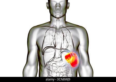 Splénomégalie. Illustration montrant une rate agrandie. Cela se produit dans les infections, la cirrhose du foie, la leucémie, le lymphome, le paludisme et les maladies auto-immunes. Banque D'Images