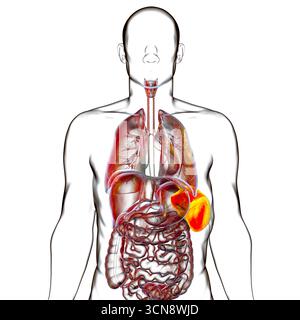 Splénomégalie. Illustration montrant une rate agrandie. Cela se produit dans les infections, la cirrhose du foie, la leucémie, le lymphome, le paludisme et les maladies auto-immunes. Banque D'Images