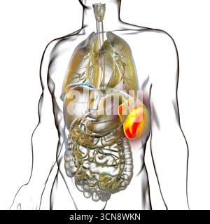Splénomégalie. Illustration montrant une rate agrandie. Cela se produit dans les infections, la cirrhose du foie, la leucémie, le lymphome, le paludisme et les maladies auto-immunes. Banque D'Images