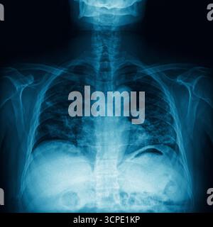 Radiographie thoracique montrant les poumons, la colonne vertébrale et les côtes avec imagerie médicale détaillée. Articulation de l'épaule, lésions des tendons et des os. Concept de film de santé Banque D'Images