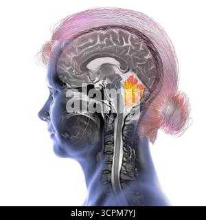 Illustration d'une imagerie par résonance magnétique (IRM) colorée du cerveau montrant le cervelet. Cette structure impliquait l'équilibre, la coordination Banque D'Images