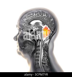 Illustration d'une imagerie par résonance magnétique (IRM) colorée du cerveau montrant le cervelet. Cette structure impliquait l'équilibre, la coordination Banque D'Images