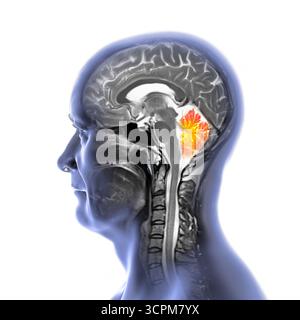 Illustration d'une imagerie par résonance magnétique (IRM) colorée du cerveau montrant le cervelet. Cette structure impliquait l'équilibre, la coordination Banque D'Images