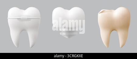 Collection de dents réaliste avec des détails d'anatomie dentaire - molaire blanche avec des accolades, implant de couronne sur tige de vis, et dent jaune. Illustrations de dentisterie médicale pour la conception de l'enseignement de la santé. Illustration de Vecteur
