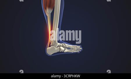 Inflammation du tendon d'Achille dans le pied Banque D'Images